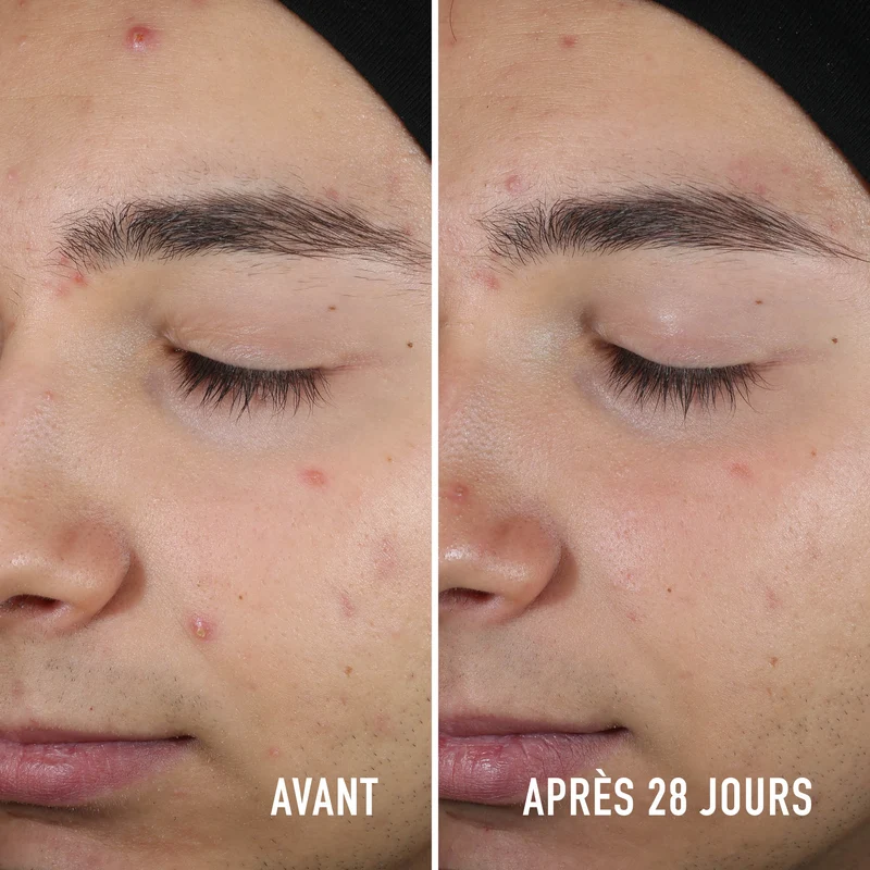 Soin Ciblé Anti-Imperfections