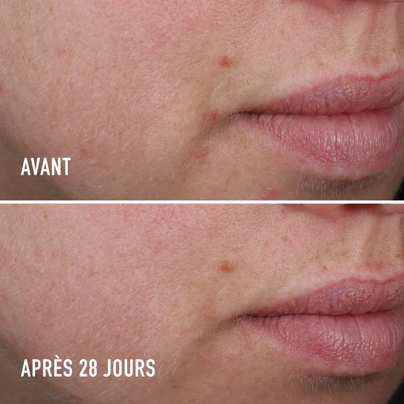Soin Ciblé Anti-Imperfections