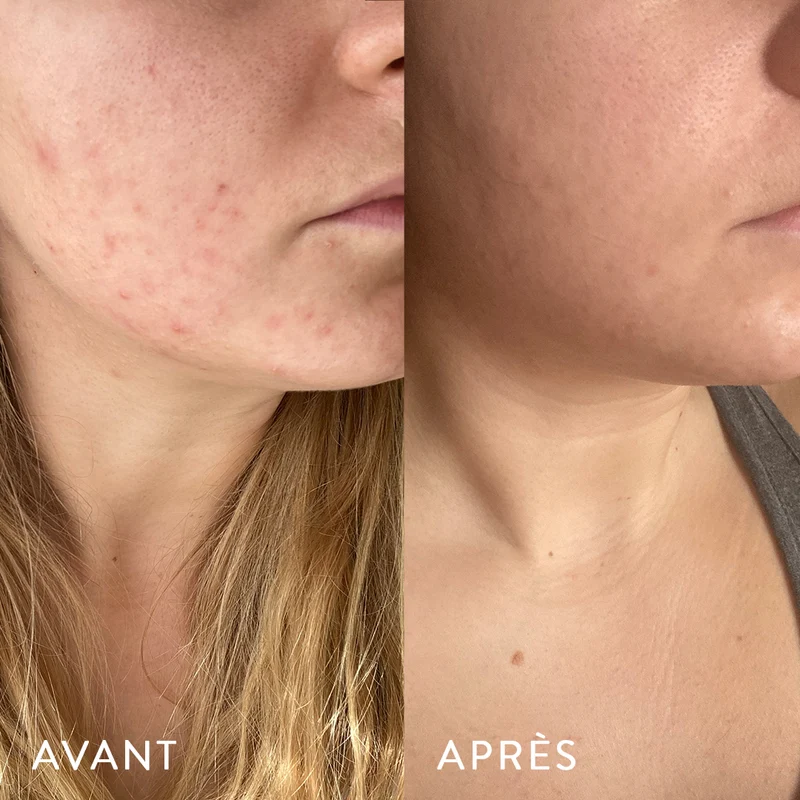 Microbiote & Peau
